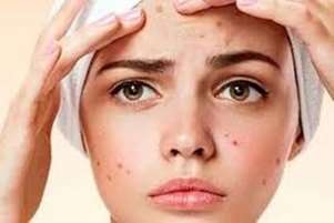نکات علمی در رابطه با ارتباط تغذیه و آکنه(قسمت دوم)