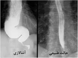 آشالازی شایع ترین اختلال حرکتی مری