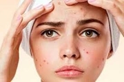 نکات علمی در رابطه با ارتباط تغذیه و آکنه(قسمت دوم)
